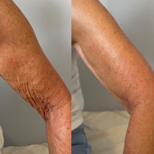 Arm Tightening at lillyrosebeauty in Murrieta, CA